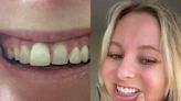 A woman spent $9,000 for veneers only for them to fall off within 24 hours — and she wants to warn others about the irreversible procedure