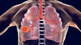 Cáncer de pulmón no microcítico en ascenso: un 16% más en 5 años