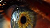 Predicting long-lasting pain from LASIK with tear proteins