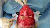 Tres mujeres se contagian de VIH tras recibir un tratamiento estético conocido como “facial vampiro”