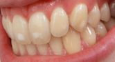 Dental fluorosis