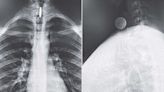 Calif. Teen Has 'Difficulty Swallowing' After Quarter Gets Stuck Vertically in Throat