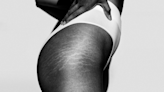 All the Ways to *Actually* Get Rid of Stretch Marks