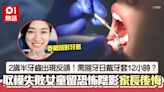 2歲半箍牙？要求日戴12小時牙套 倒模失敗女童留陰影 牙醫咁講