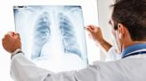 Amgen/AstraZeneca Say Asthma Drug Shows Activity In Another Lung Disease Across Broad Patient Population