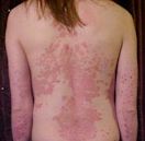 Psoriasis