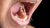 補牙用「銀粉」真的會讓你失智、慢性發炎嗎？牙醫師告訴你「銀粉的真相」
