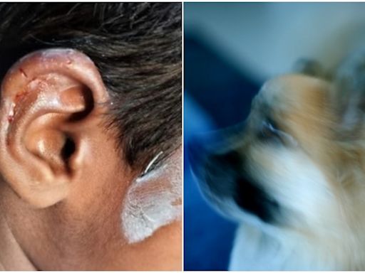 Dog Bites 5-Year-Old Child's Ear in Bengaluru, Prompting Online Debate Over Pet Safety Rules