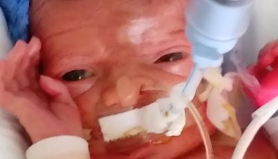 'My baby has an extremely rare skin condition - doctors don't think he'll survive'