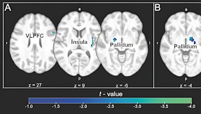 Imaginary placebo intake study investigates neural response for regulating disgust