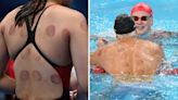 Why do Olympic swimmers have circles on their bodies? Cupping therapy benefits explained