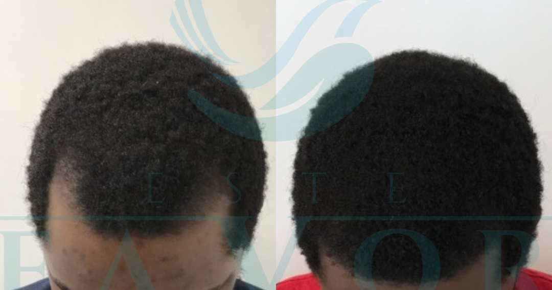 Best Afro hair transplant clinics in Turkey and Afro hair transplant prices 2024