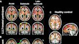 Light therapy increases brain connectivity following injury, study finds