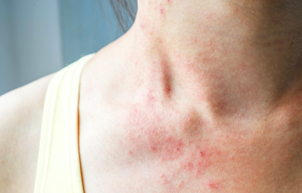 These Pictures Will Help You Identify the Most Common Skin Rashes