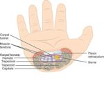 Carpal tunnel