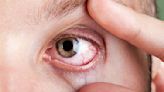 Las causas por las que el ojo se pone rojo con sangre: ¿Cuándo debes acudir a un médico?