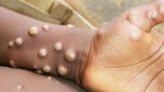 India's Monkeypox Update: Closely Monitoring Situation, Measures Put In Place, Says Centre