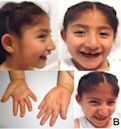 Angelman syndrome