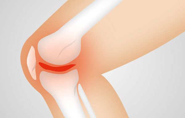 Novel technique helps predict risk of a meniscus tear in the knee