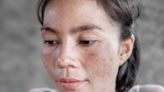 What to Know About Melasma in Pregnancy