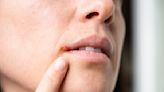 The #1 Thing Most People Don't Know Can Cause a Cold Sore, According to Dermatologists