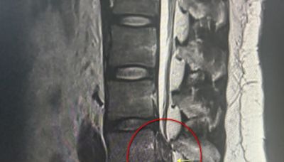 30歲破百公斤男子苦於椎間盤突出 脊椎內視鏡手術摘除病灶 - 自由健康網