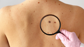 Here’s what to expect at your skin cancer screening exam