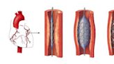 正確認識冠狀動脈支架 避免血路不通
