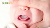 寶寶嘴巴出現白點或血點 小心念珠菌感染引發「鵝口瘡」 | 蕃新聞