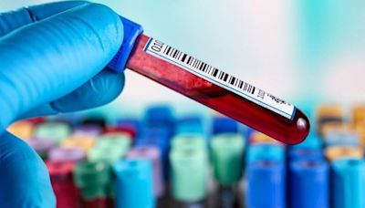 Blood Test 91% Accurate at Predicting Alzheimer's, Outperforming Doctors