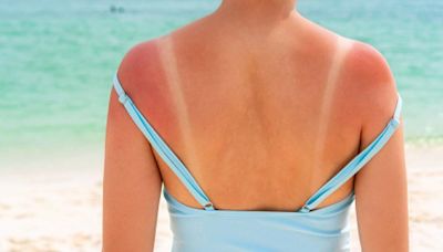 8 ways to help soothe your painful heatwave sunburn