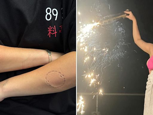 Billie Eilish sparks concern as she shares photos with bite marks