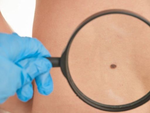 I didn't know what I needed to know about skin cancer. That was my fault | George Korda