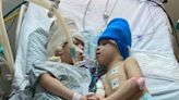 Conjoined twins whose brains were fused together have been separated in a 27-hour surgery