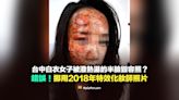 【錯誤】台中白衣女子被潑熱湯的半臉毀容照？挪用2018年特效化妝師照片