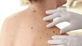 ¿Cómo saber si tienes un melanoma? Cinco síntomas con los que debes estar alerta