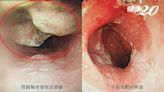 6旬男「胸腹部微痛、解黑便」一照竟是食道癌！醫：多吃這營養素可防癌