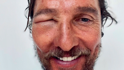 Matthew McConaughey Shares Photo of Bee Sting That Made His Eye Swell Shut