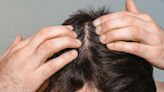 4 Things to Know About DHT Blockers for Hair Loss