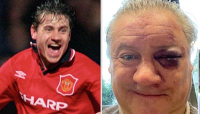 Unrecognisable ex-Man Utd star shows off gruesome black eye after 'bar attack'
