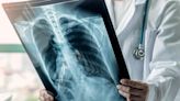AI-based lung cancer screening in Karnataka detects 133 lung nodule malignancy and nearly 3,000 TB-presumptive cases in last nine months
