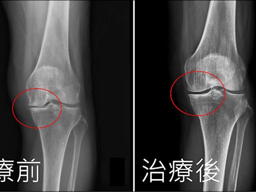 膝關節退化 自體免疫細胞治療改善痠痛 - 自由健康網