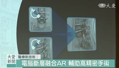 高精密主動脈手術 電腦斷層融合輔助