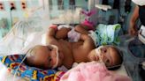 Cook Children’s surgeons separate conjoined twins for first time in hospital history