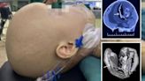 Toddler dies days after doctors discover 'twin sister's foetus' in her SKULL