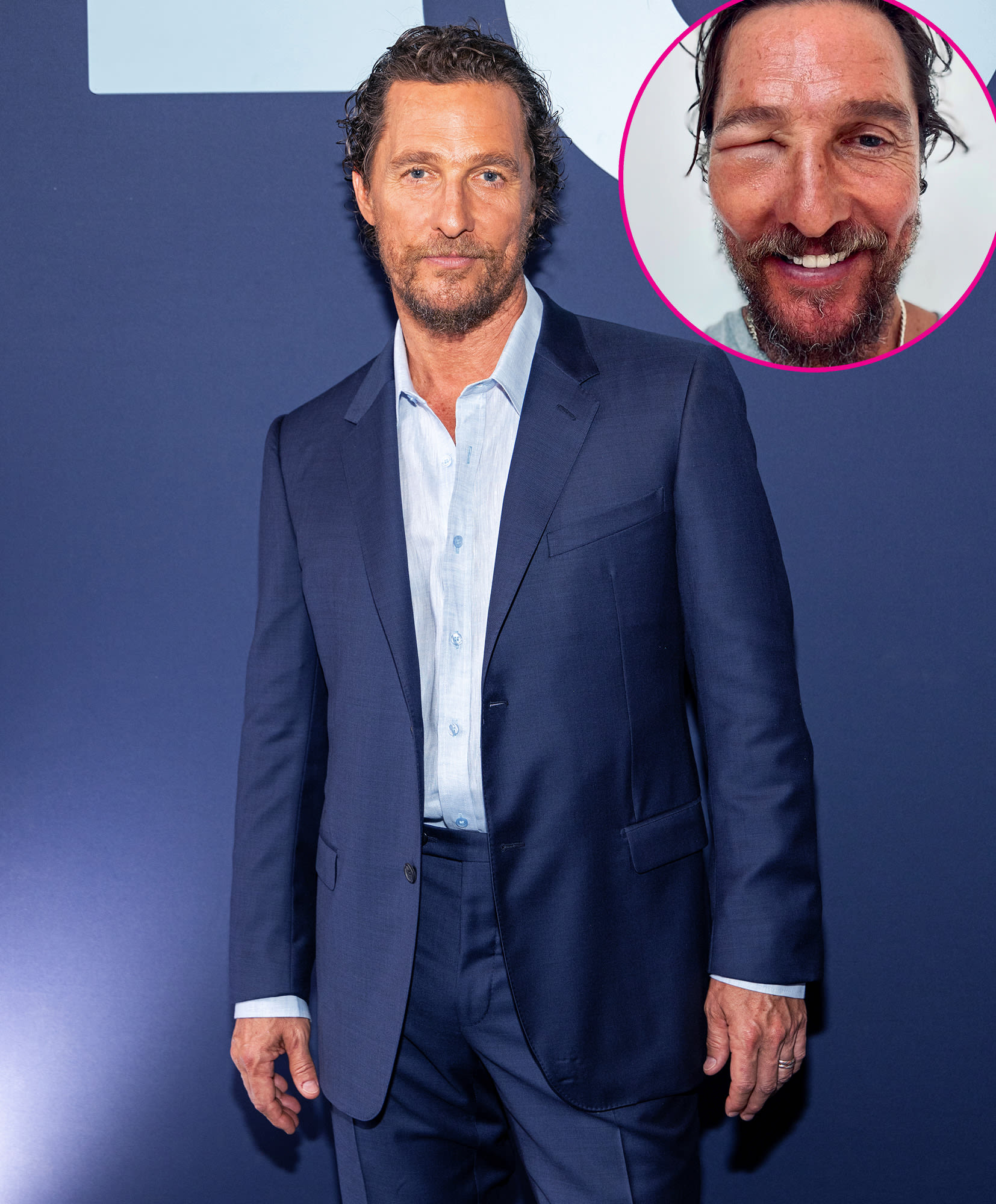 Matthew McConaughey’s Eye Is Swollen Shut After Bee Sting: ‘Bee Swell’