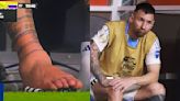 ARG vs COL, Copa America 2024 Final: Lionel Messi's Swollen Ankle Leaves Fans In Shock, Say 'It Looks Destroyed'