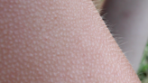 Why we don’t notice most of our goosebumps