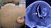 ‘Gêmeo parasita’: médicos encontram feto com braços, cabelos e olhos dentro do crânio de bebê de 1 ano
