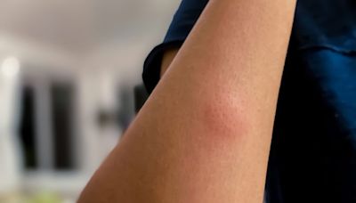 How to Get Rid of Mosquito Bites ASAP